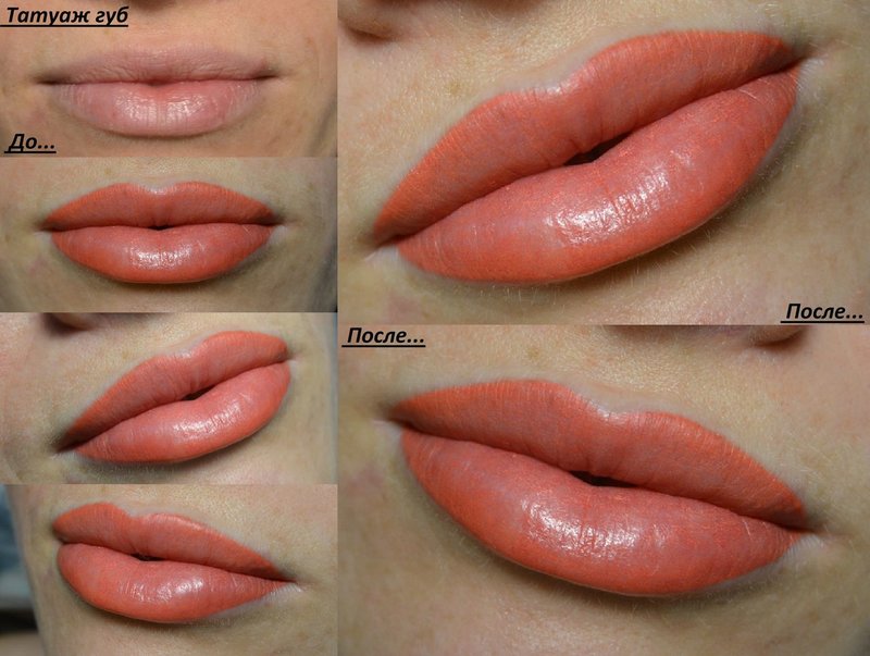 Photos before and after the procedure