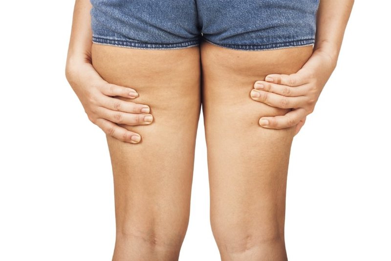 Small cellulite on the legs Causes of the appearance of cellulite