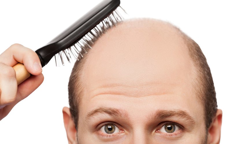 Smirnov hair loss Smirnov hair loss