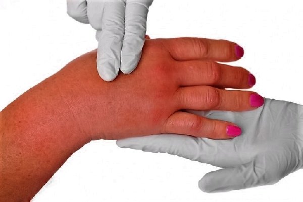 Conspiracy - prayer from erysipelas on the leg