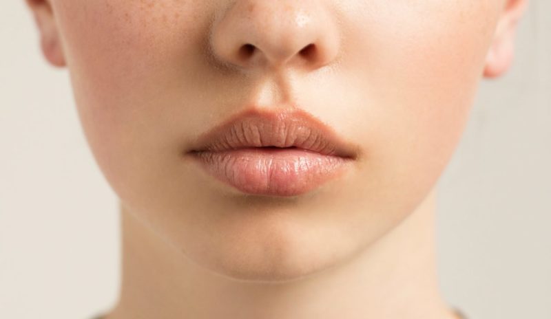 Lip augmentation Increased losses