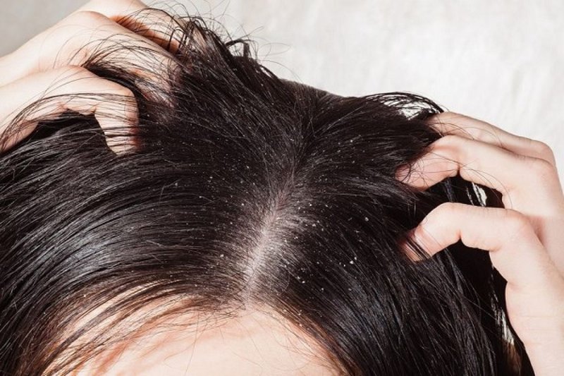 Anti-dandruff Anti-dandruff