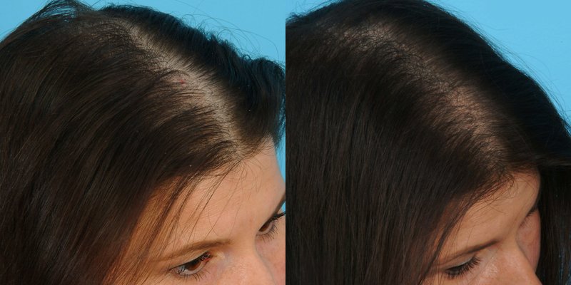 Hair loss treatment