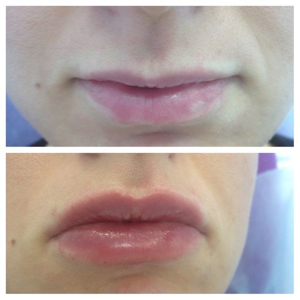 Lip augmentation with hyaluronic acid Lip augmentation with hyaluronic acid