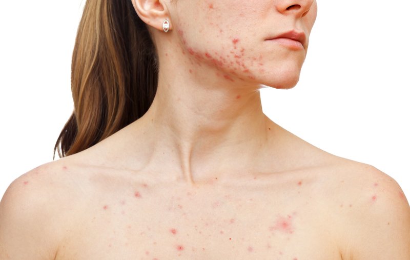 Dermatitis on the face and body Dermatitis