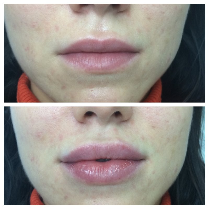 Lip augmentation with hyaluronic acid Lip augmentation with hyaluronic acid