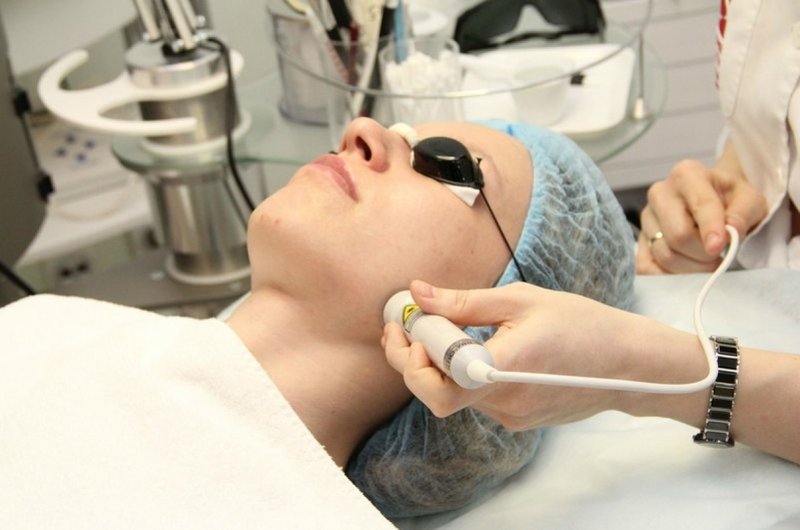 Laser biorevitalization procedure Laser biorevitalization procedure