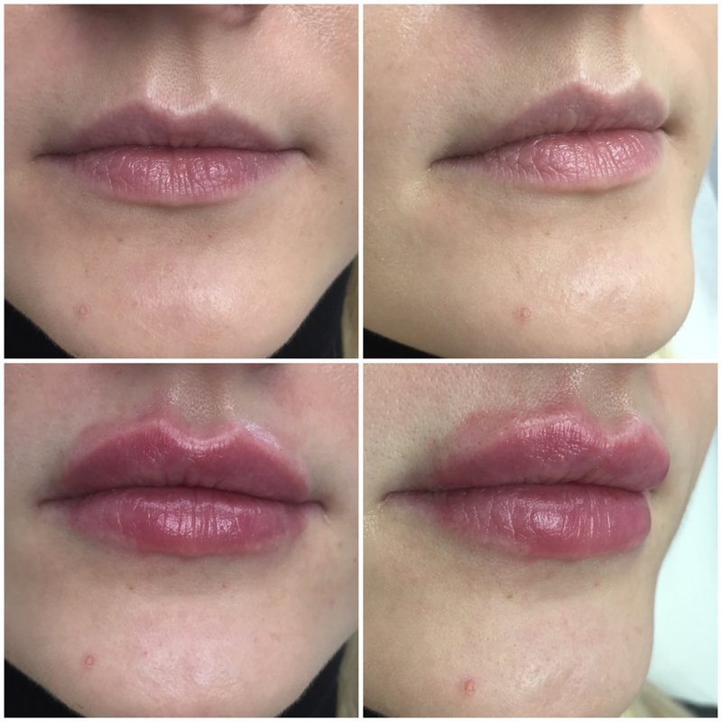 Lip augmentation with hyaluronic acid Lip augmentation with hyaluronic acid