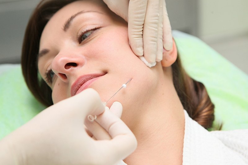 Thread lifting Thread lifting