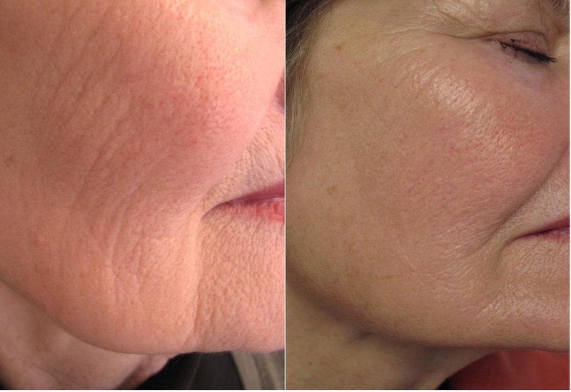 Treatment with Revi Brilliants: Before and After Treatment with Revi Brilliants: Before and After