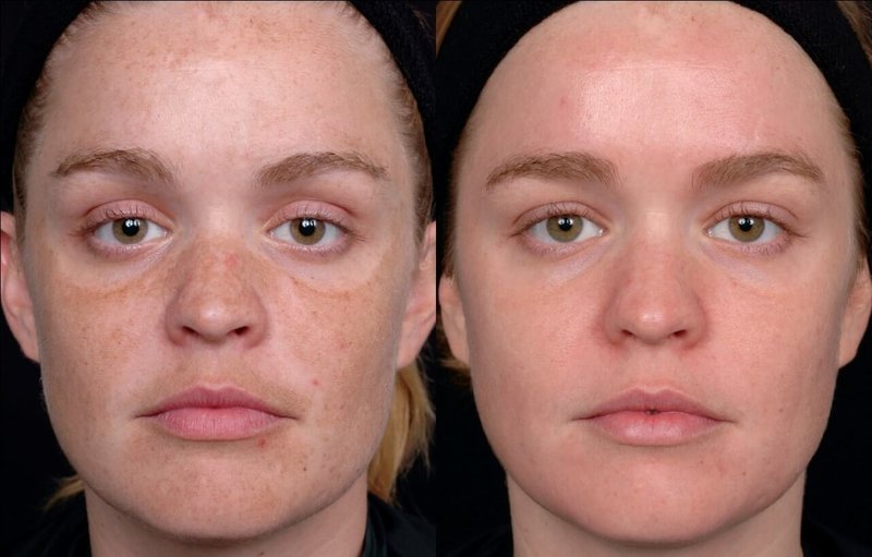 Before and after laser facial cleansing Before and after laser facial cleansing