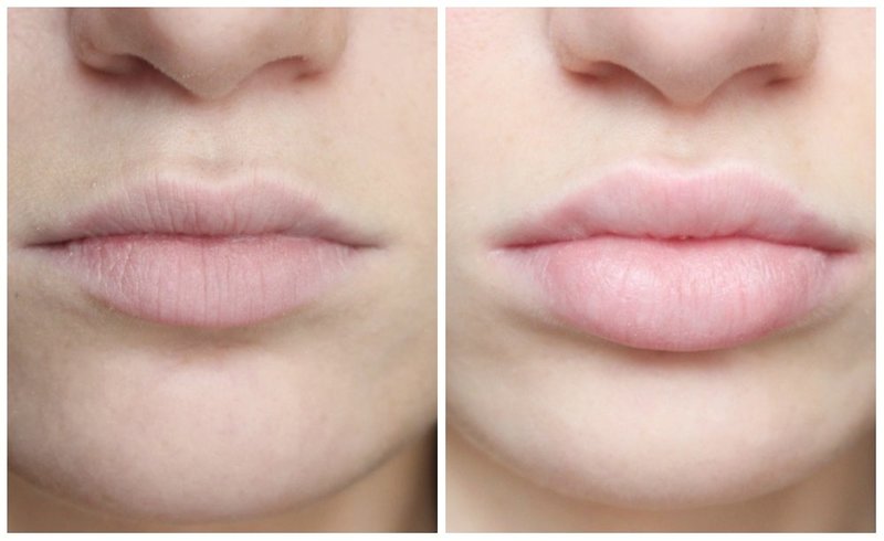 Lip augmentation with hyaluronic acid Lip augmentation with hyaluronic acid