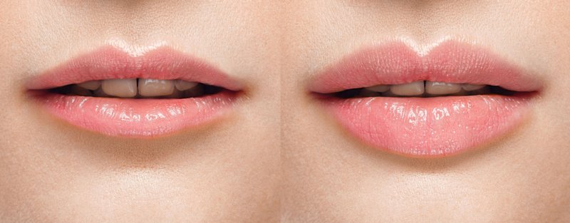 Lip augmentation with hyaluronic acid Lip augmentation with hyaluronic acid