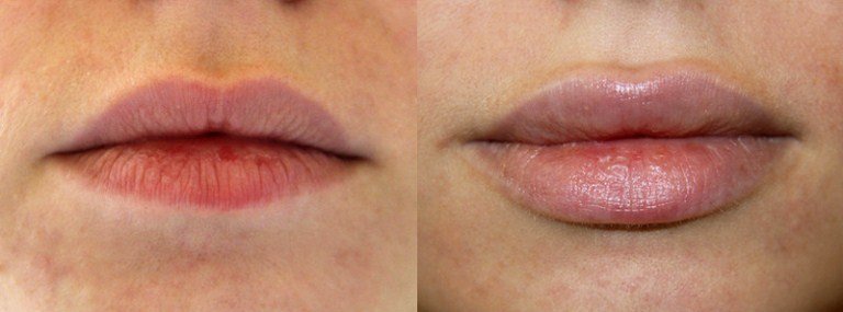 Lip augmentation with hyaluronic acid Lip augmentation with hyaluronic acid