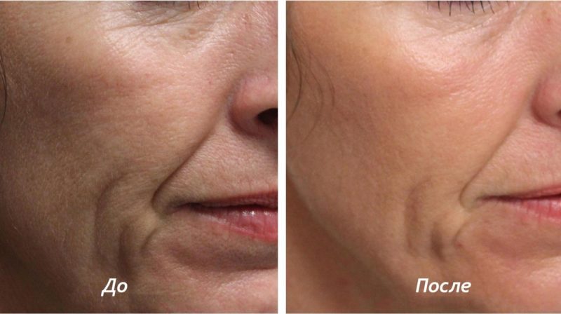 Biorevitalization with Revi: before and after Biorevitalization with Revi: before and after