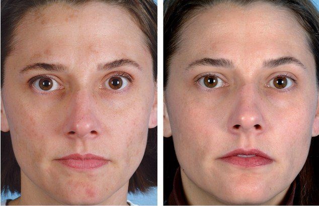 Before and after vacuum facial cleansing Before and after vacuum facial cleansing