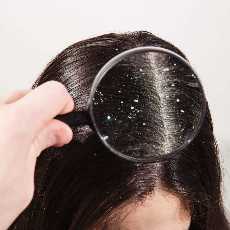 Examination of dandruff under a magnifying glass