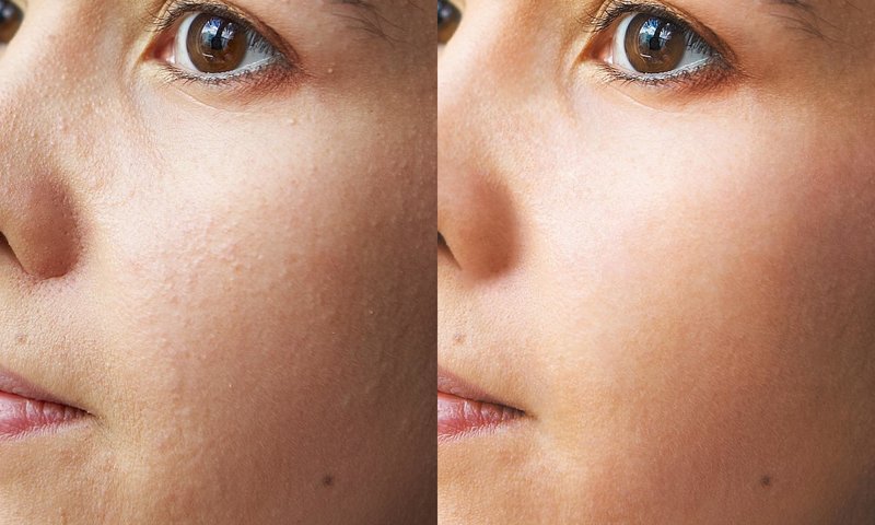Before and after ultrasonic facial cleansing Before and after ultrasonic facial cleansing