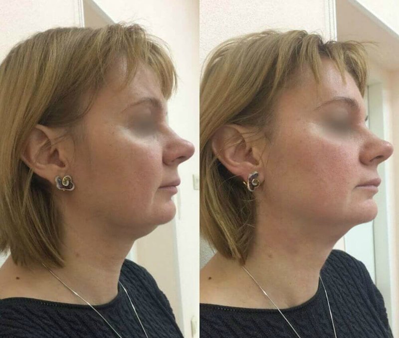 The benefits of hardware SMAS lifting The benefits of hardware SMAS lifting