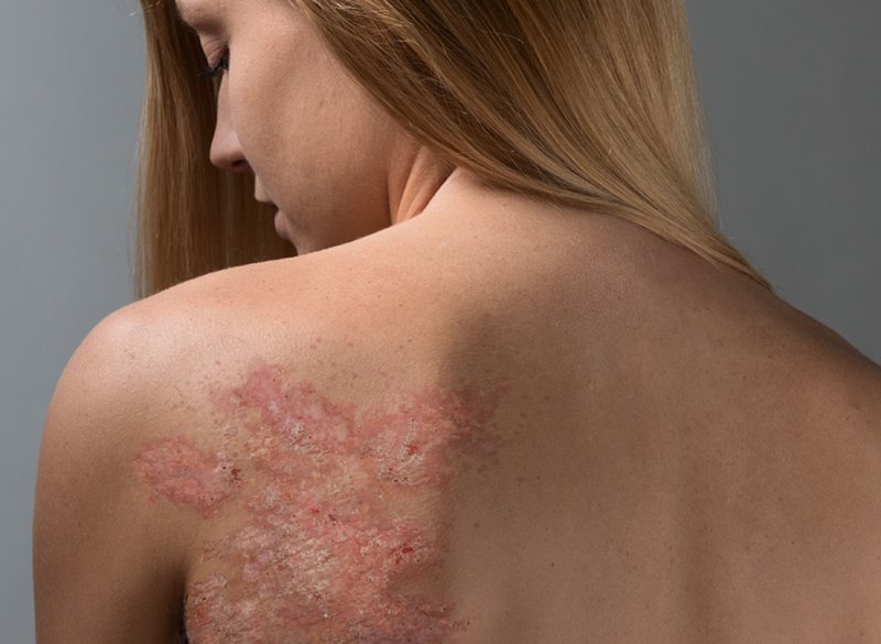 Psoriasis on the body Psoriasis on the body