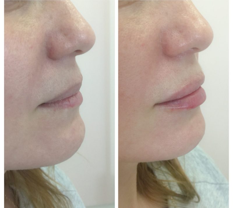 Lip augmentation with hyaluronic acid Lip augmentation with hyaluronic acid