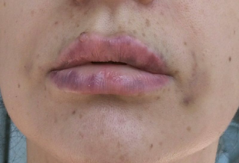 The consequences of unsuccessful lip augmentation The consequences of unsuccessful lip augmentation