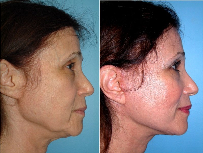 Circular face and neck lift with Kogi threads Circular face and neck lift with Kogi threads