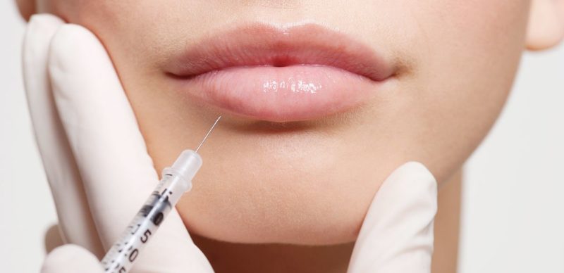 Hyaluronic acid injection in the lips Hyaluronic acid injection in the lips