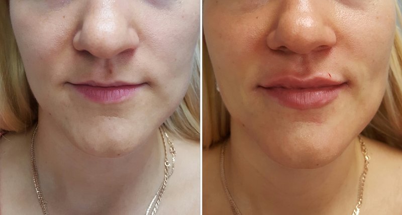 Lip augmentation with hyaluronic acid Lip augmentation with hyaluronic acid