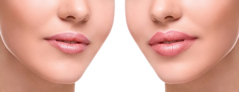 Lip augmentation with hyaluronic acid Lips enlarged fillers (before and after)