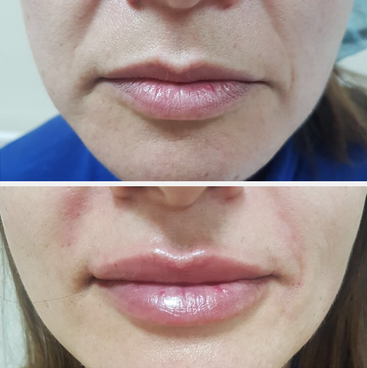 Lip augmentation with hyaluronic acid Lip augmentation with hyaluronic acid