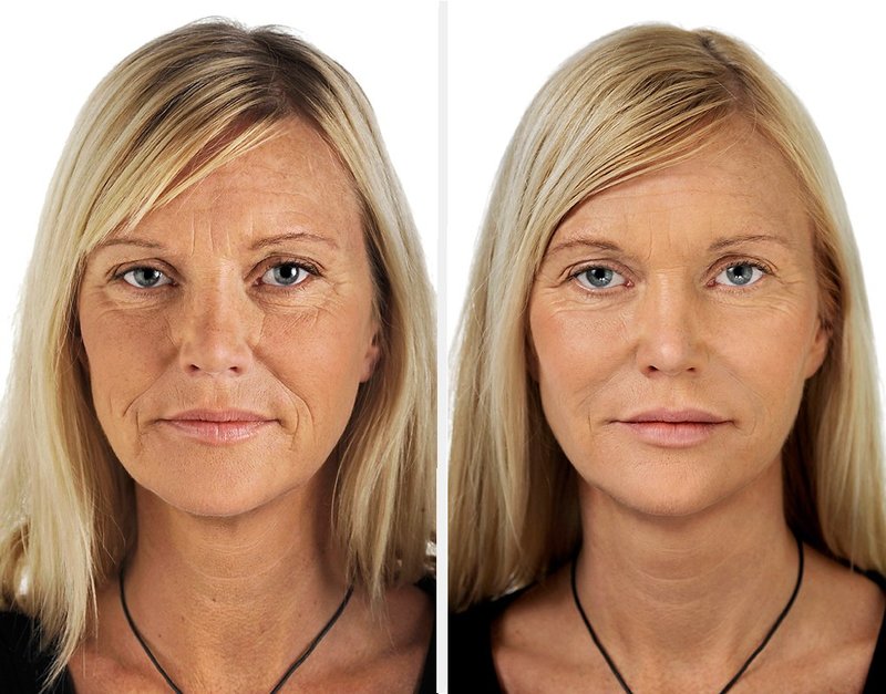 The result of the procedures The result of the procedures