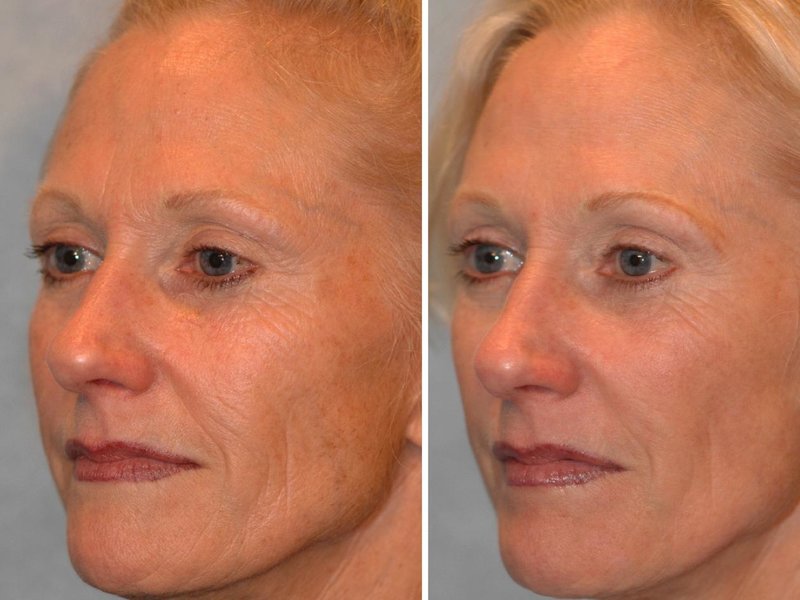 The result of Revi Brilliants: before and after The result of Revi Brilliants: before and after