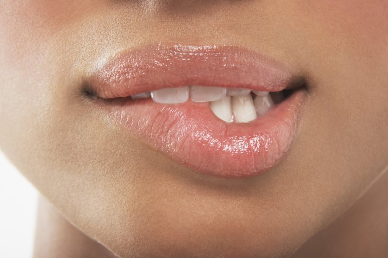 Lips after hyaluronic acid enlargement Lips