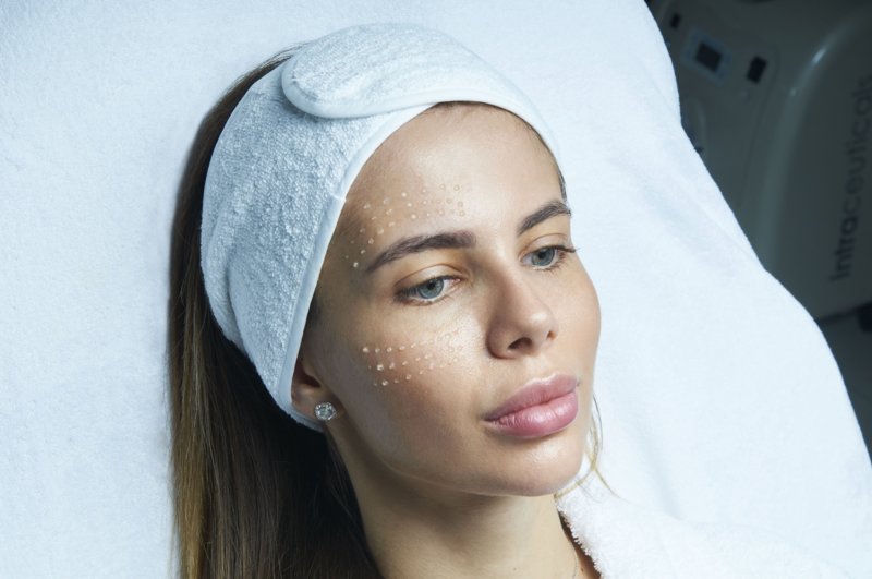 Leaked hyaluronic acid preparation at puncture sites Leaked hyaluronic acid preparation at puncture sites