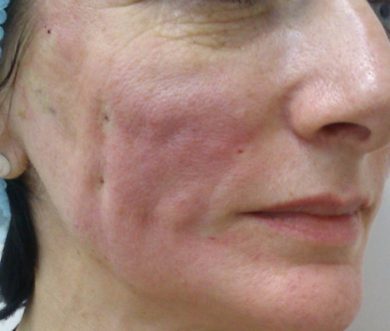 The consequences of net lifting