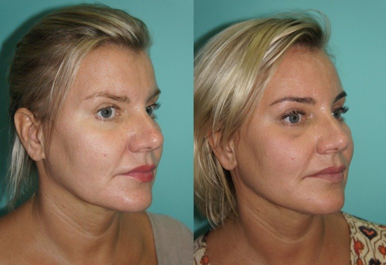 Circular lifting with Kogi threads Circular lifting with Kogi threads