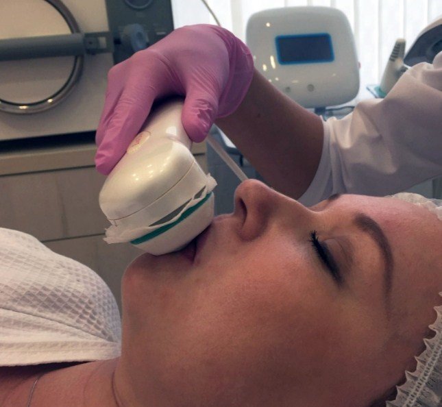 Electroporation of lips Electroporation of lips