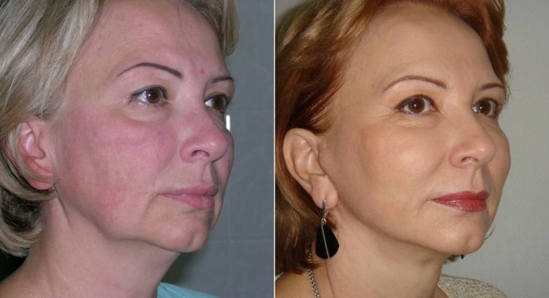 Cheek lift and nasolabial fold removal Cheek lift and nasolabial fold removal