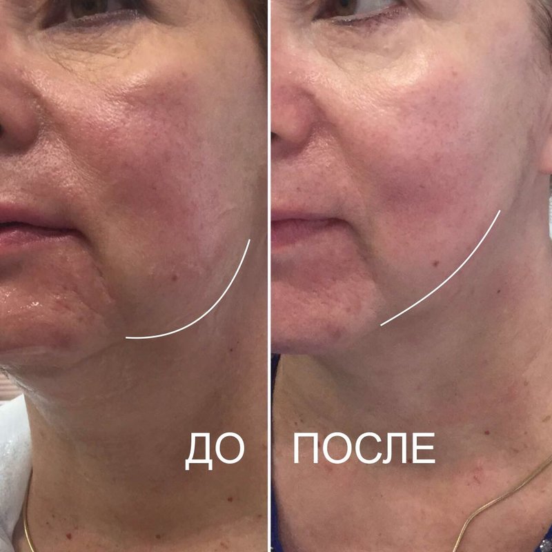 SMAS lifting results before and after SMAS lifting results