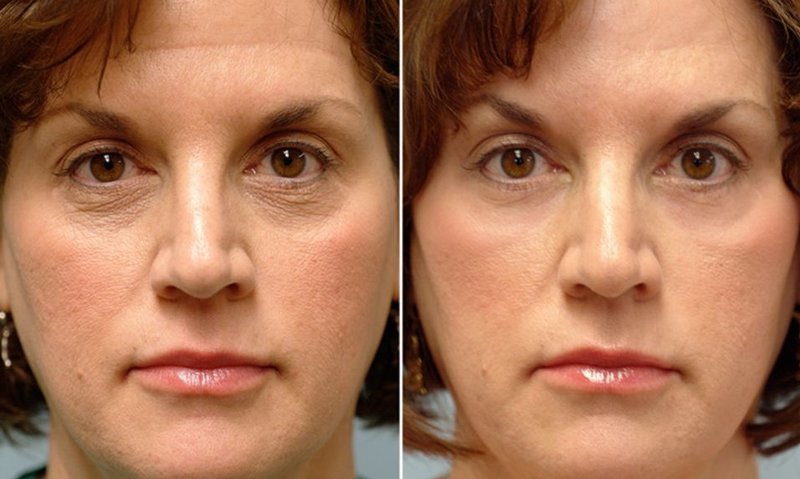 Face correction with RF lifting 10 procedures Face correction with RF lifting 10 procedures