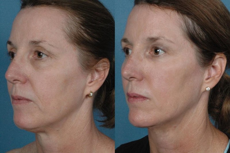 Correction of the chin and nasolabial folds with RF lifting 4 procedures Correction of the chin and nasolabial folds with RF lifting 4 procedures
