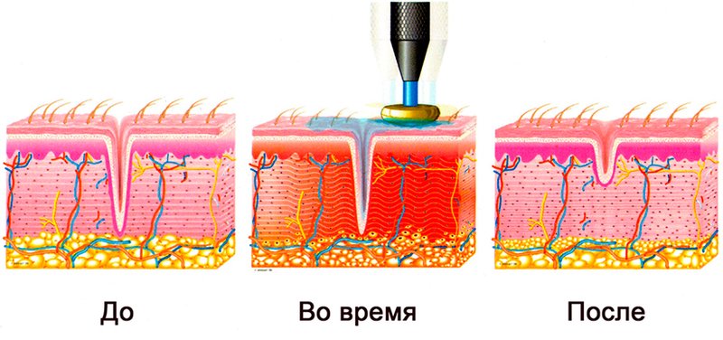 The mechanism of exposure to RF lifting The mechanism of exposure to RF lifting