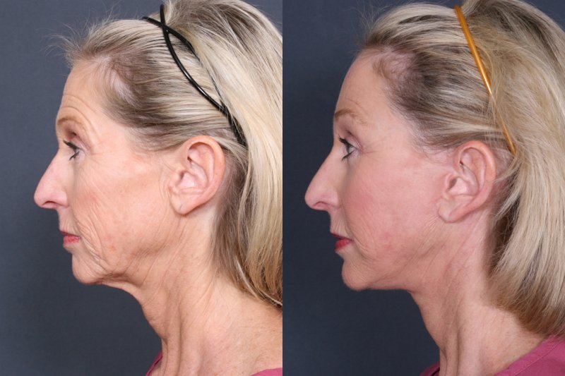 Circular facelift Circular facelift