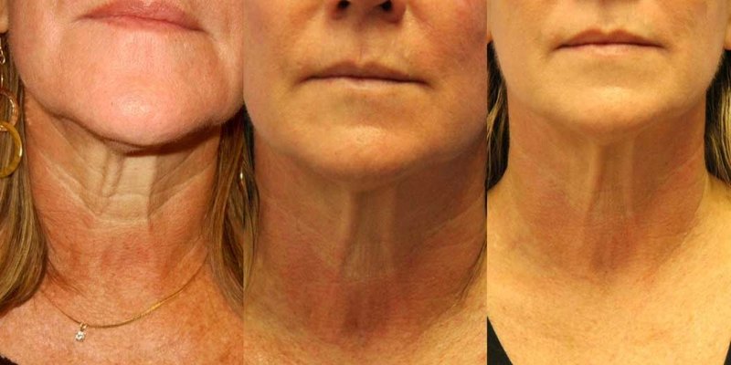 Correction of the neck with RF lifting 4 procedures Correction of the neck with RF lifting 4 procedures