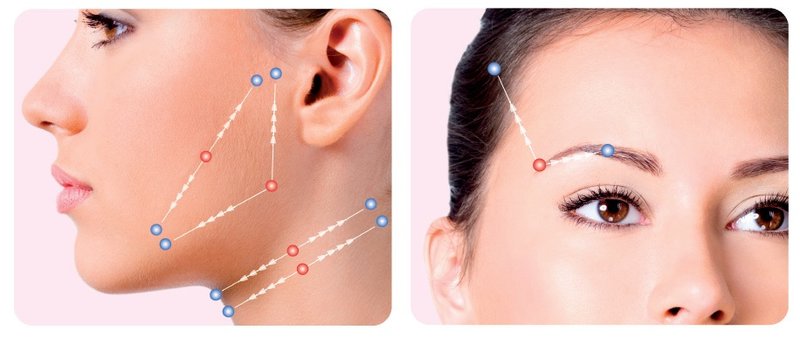 What is the procedure for introducing mesothreads?