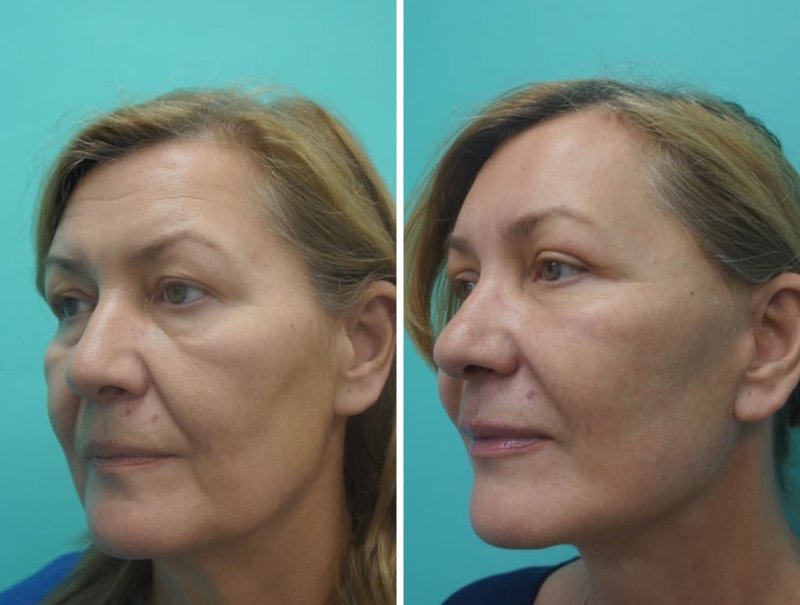 Hardware face and neck lift: review Hardware face and neck lift: review