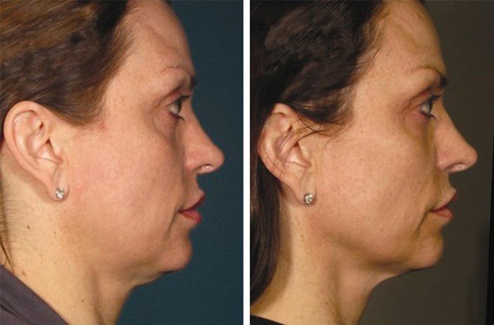 The result of SMAS lifting The result of SMAS lifting