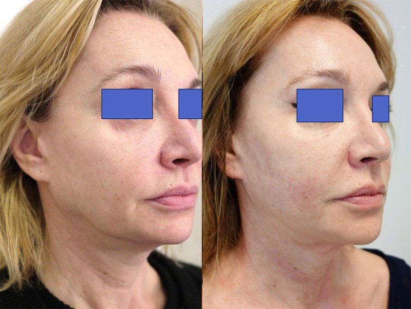 Real reviews about SMAS lifting: before and after photos Real reviews about SMAS lifting: before and after photos