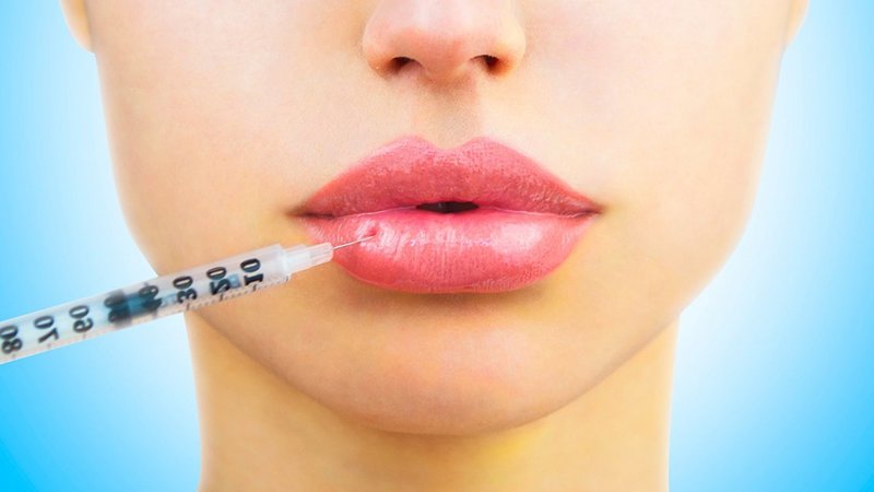 Lip augmentation with hyaluronic acid Lip augmentation with hyaluronic acid